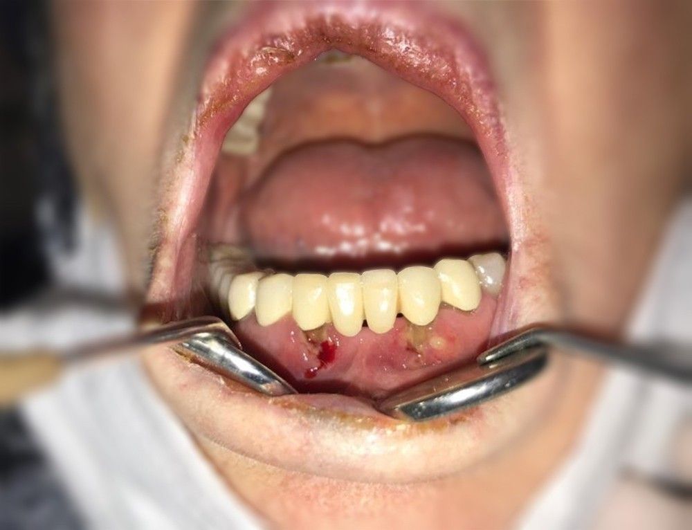 Covid-19'un oral bulguları