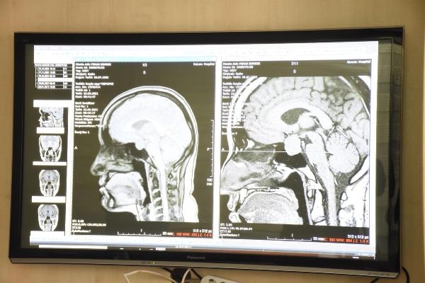 Beyin tümörü bulunan hastaya burundan girilerek ameliyat