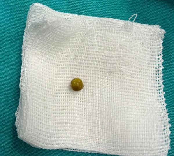 Akciğerine kaçan bezelye ameliyatla çıkarıldı