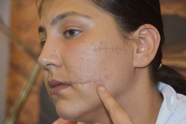 Canavarca hisle yaralamadan dava açıldı